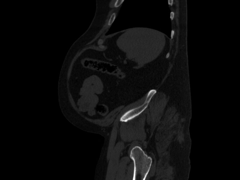 File:Ankylosing spondylitis (Radiopaedia 44609-48357 Sagittal bone window 97).jpg