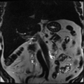 Annular pancreas (Radiopaedia 38292-40320 Coronal T2 13).png