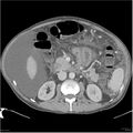 Annular pancreas and cirrhosis (Radiopaedia 24561-24843 A 11).jpg