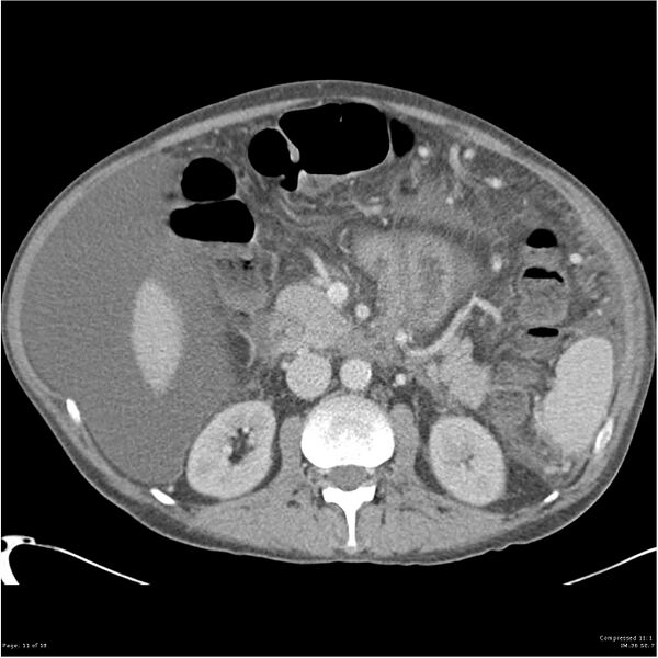File:Annular pancreas and cirrhosis (Radiopaedia 24561-24843 A 11).jpg