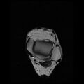 Anterior calcaneal process fracture (Radiopaedia 74654-85611 Axial T2 6).jpg