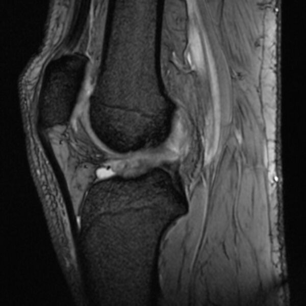 File:Anterior cruciate ligament tear - ramp lesion (Radiopaedia 71883-82322 Sagittal T2 fat sat 12).jpg