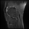 Anterior cruciate ligament tear with posteromedial corner injury, bucket-handle meniscal tear and chondral delamination (Radiopaedia 75501-86744 Sagittal PD fat sat 22).jpg