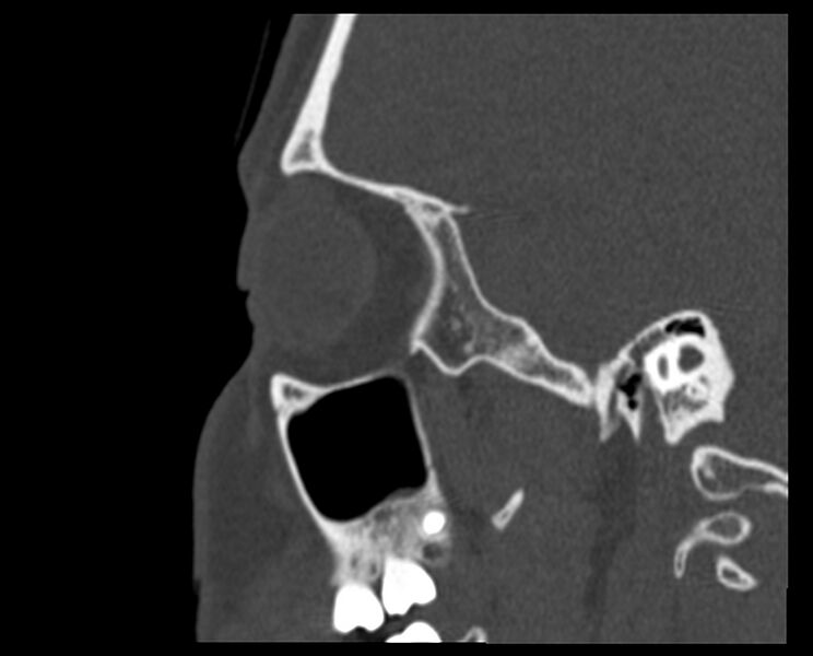 File:Antrochoanal polyp (Radiopaedia 21894-21868 Sagittal bone window 35).jpg