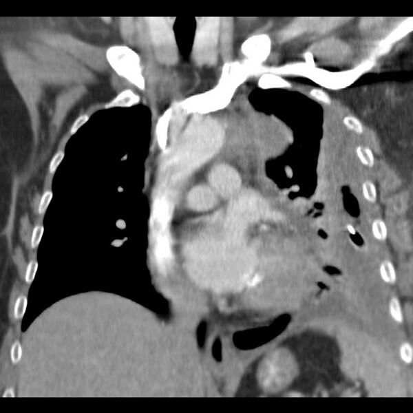 File:Aortic arch false aneurysm (Radiopaedia 14667-14588 B 4).jpg
