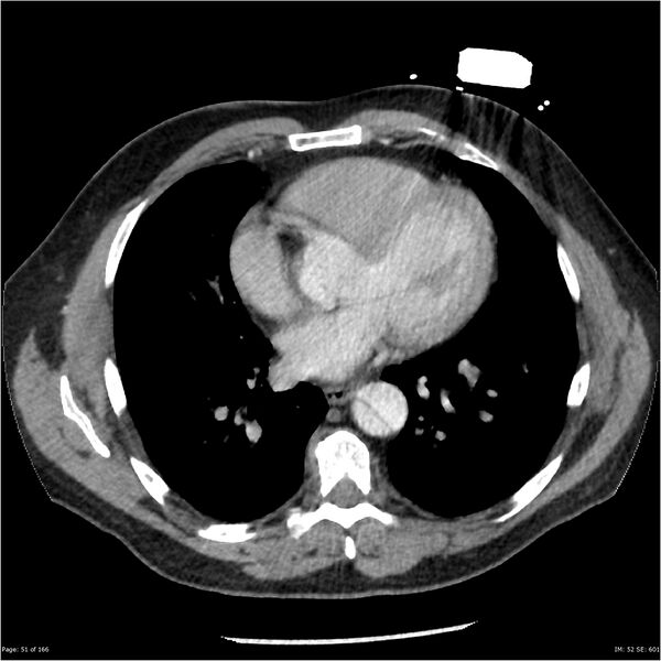 File:Aortic dissection- Stanford A (Radiopaedia 37759-39664 A 42).jpg