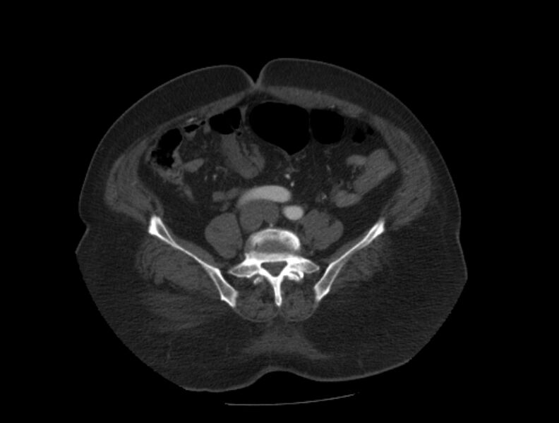 File:Aortic dissection (Radiopaedia 28802-29105 A 80).jpg