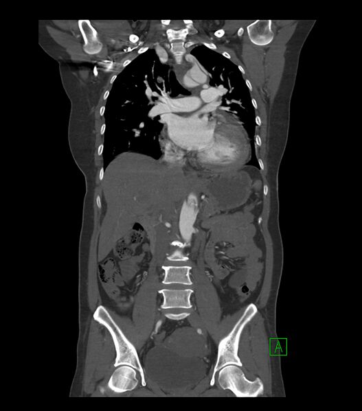 File:Aortic dissection with renal ischemia (Radiopaedia 76573-88338 C 14).jpg