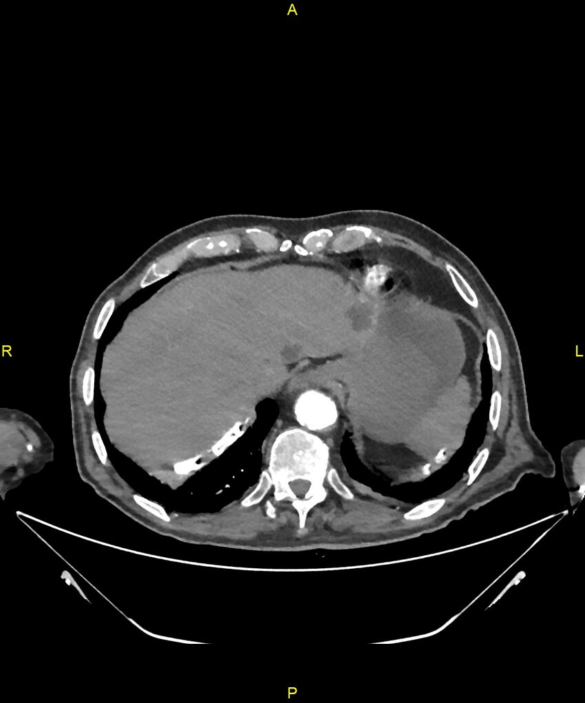 Aortoenteric fistula (Radiopaedia 84308-99603 B 30).jpg