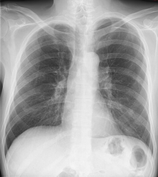 File:Apical pneumothorax (Radiopaedia 62710).JPG