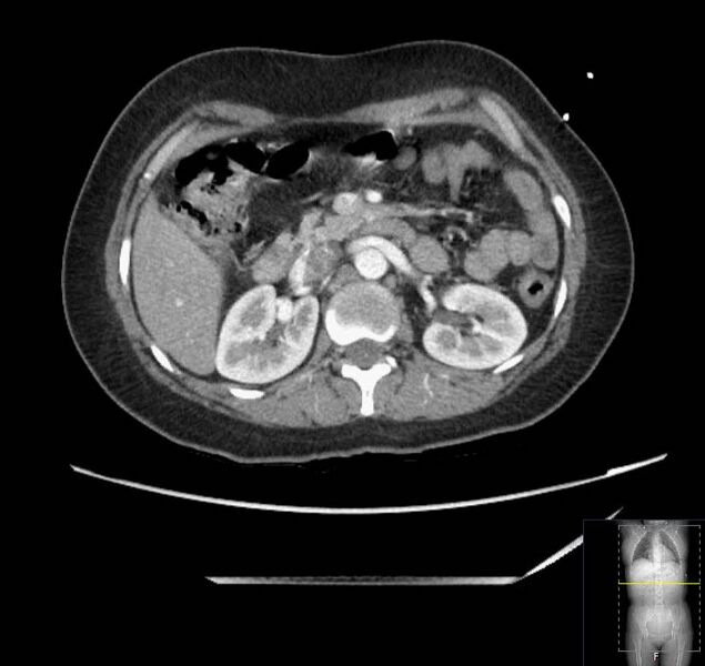 File:Appendicitis (CT angiogram) (Radiopaedia 154713-127660 Axial 123).jpg