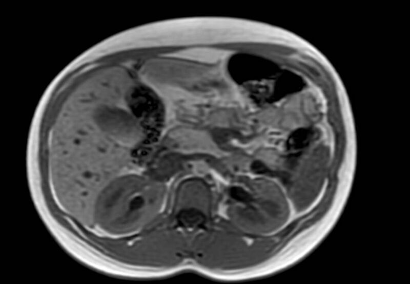 File:Appendicitis in gravida (MRI) (Radiopaedia 89433-106395 Axial T1 in-phase 21).jpg