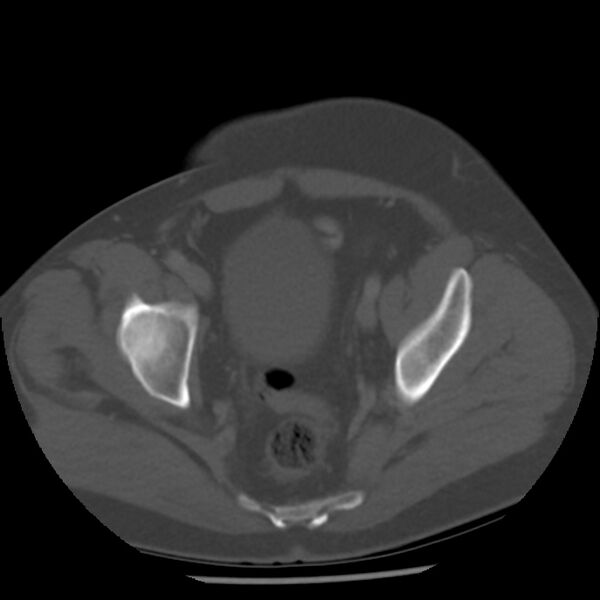 File:Appendicitis with perforation (Radiopaedia 35790-37342 Axial bone window 46).jpg