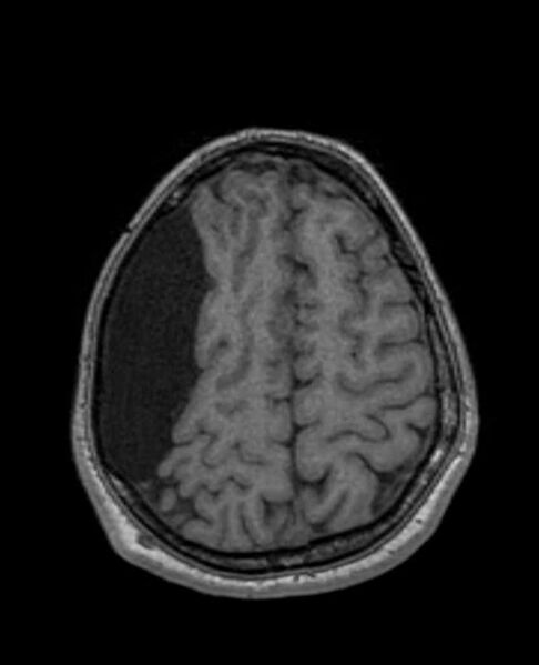 File:Arachnoid cyst- extremely large (Radiopaedia 68741-78451 Axial T1 62).jpg