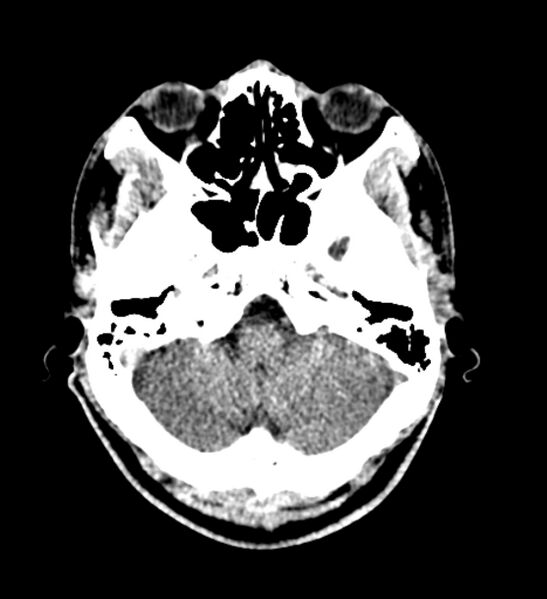 File:Arachnoid cyst of the ambient cistern (Radiopaedia 81301-94986 Axial non-contrast 13).jpg