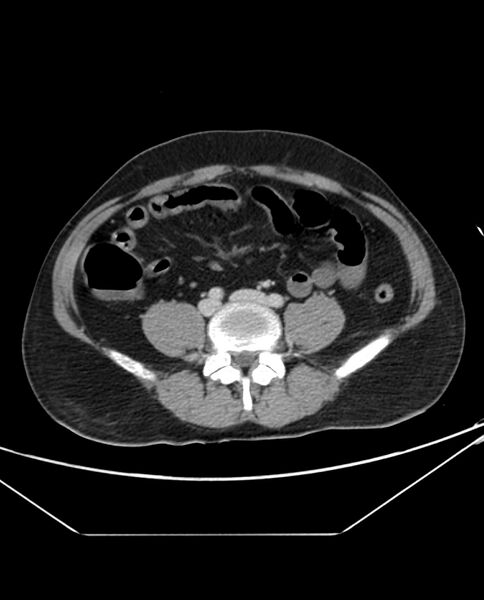 File:Arterial occlusive mesenteric ischemia (Radiopaedia 84641-100054 A 79).jpg