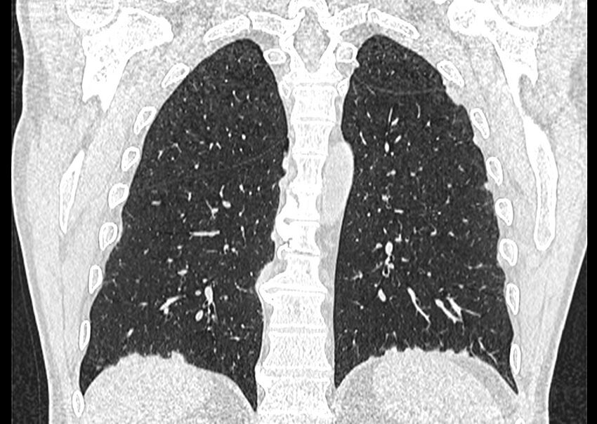 Asbestos pleural placques (Radiopaedia 57905-64872 Coronal lung window 215).jpg