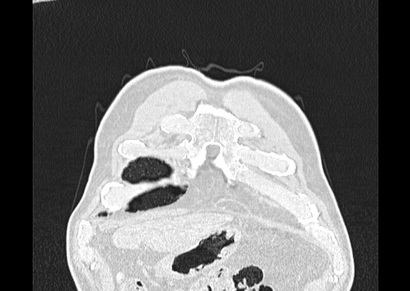 File:Asbestos pleural placques (Radiopaedia 57905-64872 Coronal lung window 9).jpg
