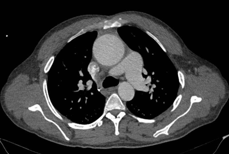 File:Ascending aortic aneurysm (Radiopaedia 86279-102297 C 19).jpg