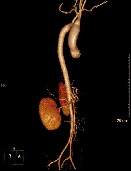 File:Ascending aortic pseudoaneurysm (Radiopaedia 28638-28910 D 5).jpg