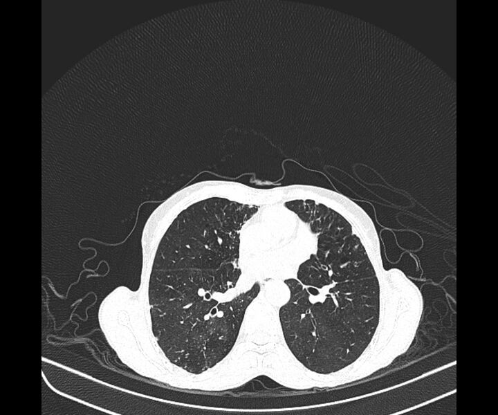 File:Aspergillomas (Radiopaedia 66779-76110 Axial lung window 26).jpg