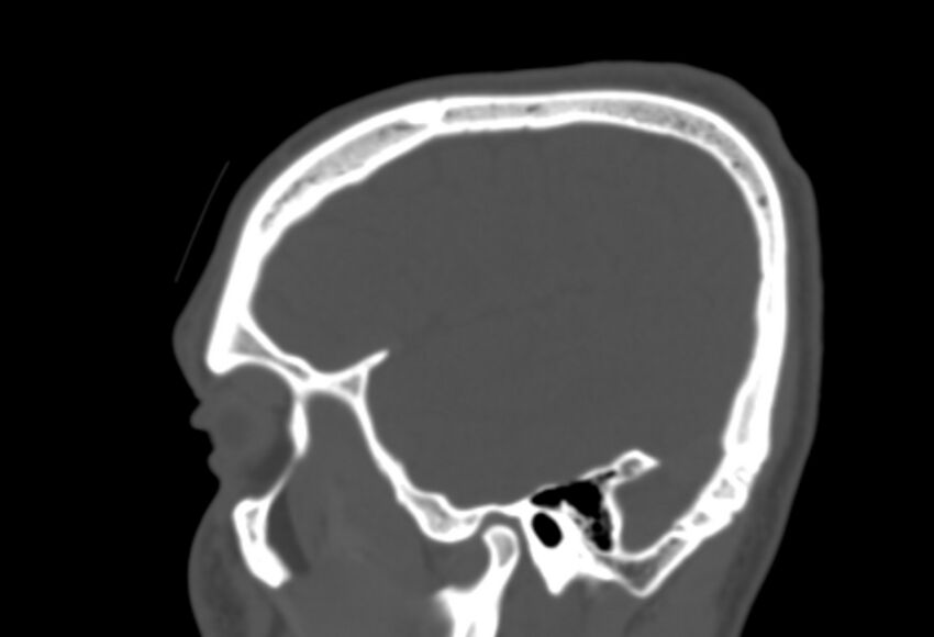 Asymptomatic occipital spur (Radiopaedia 87753-104201 Sagittal bone window 48).jpg