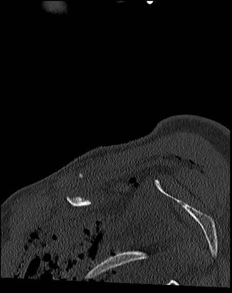 File:Atlanto-occipital dissociation - Traynelis type 1 (Radiopaedia 87570-103948 Sagittal bone window 2).jpg