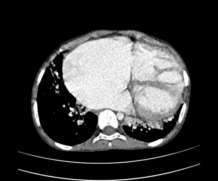 File:Atrial septal defect complicated by Eisenmenger syndrome (Radiopaedia 53707-59768 Axial C+ CTPA 25).jpg