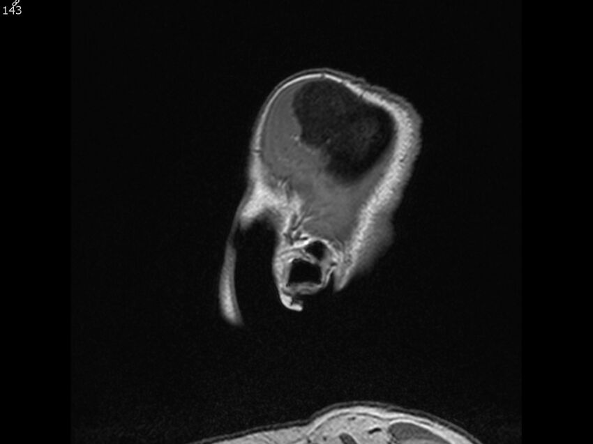 Atypical meningioma - intraosseous (Radiopaedia 64915-74572 Sagittal T1 143).jpg