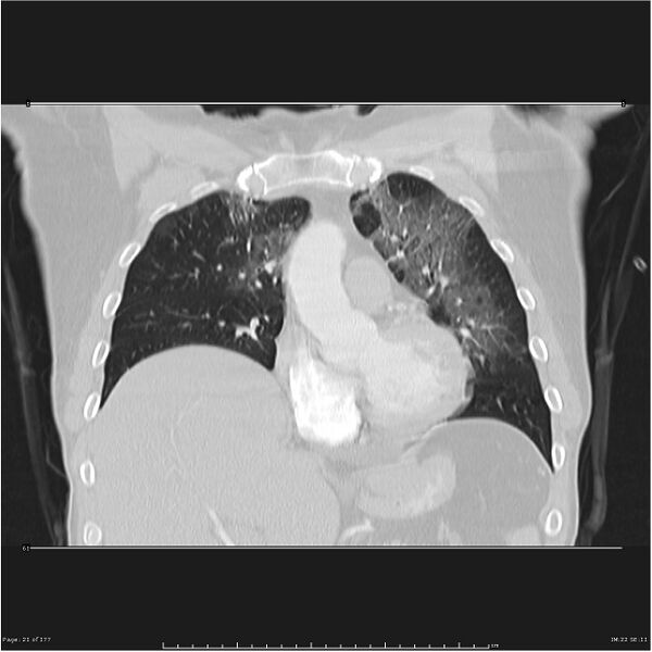 File:Atypical pneumonia - Q fever (Radiopaedia 21993-21989 C 14).jpg