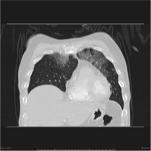 File:Atypical pneumonia - Q fever (Radiopaedia 21993-21989 C 7).jpg