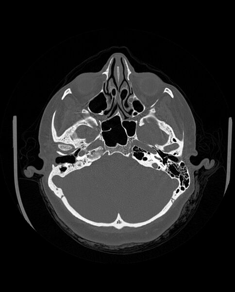 File:Automastoidectomy with labyrinthine fistula (Radiopaedia 84143-99411 Axial non-contrast 82).jpg
