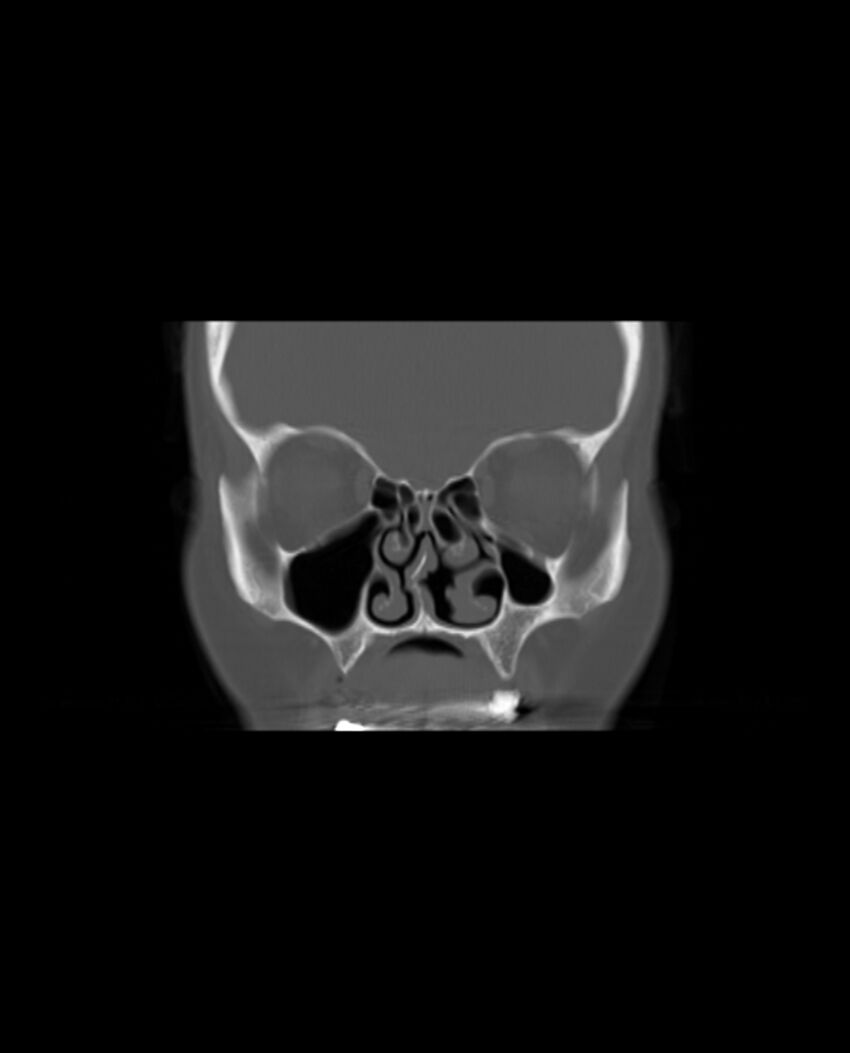Automastoidectomy with labyrinthine fistula (Radiopaedia 84143-99411 Coronal non-contrast 29).jpg
