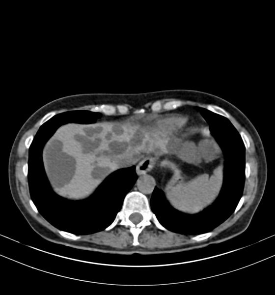 File:Autosomal dominant polycystic kidney disease (Radiopaedia 41918-44922 Axial non-contrast 1).jpg