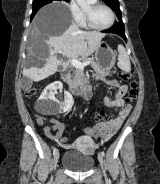 File:Autosomal dominant polycystic kidney disease (Radiopaedia 57124-64017 B 34).jpg