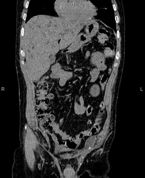 File:Autosomal dominant polycystic kidney disease (Radiopaedia 87830-104287 Coronal non-contrast 15).jpg