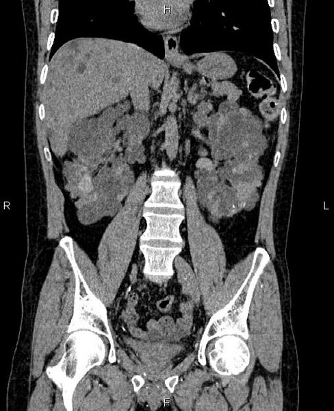 File:Autosomal dominant polycystic kidney disease (Radiopaedia 87830-104287 Coronal non-contrast 34).jpg