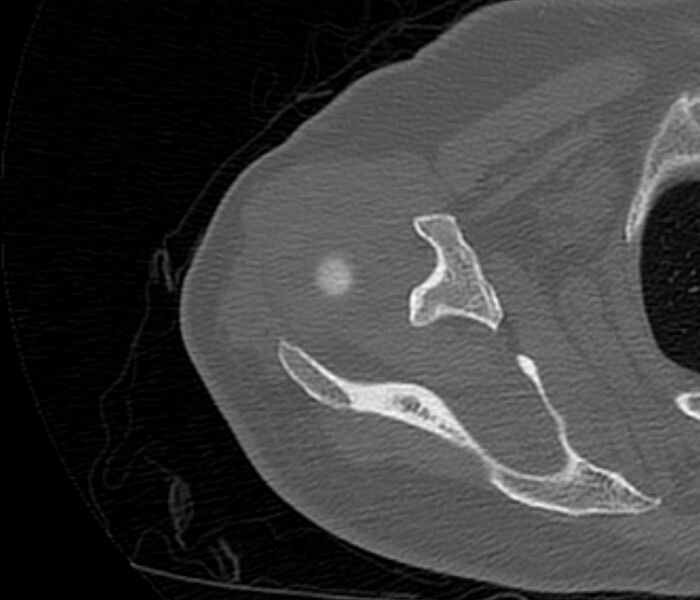 File:Avulsion fracture - greater tuberosity of humerus (Radiopaedia 71216-81514 Axial bone window 24).jpg