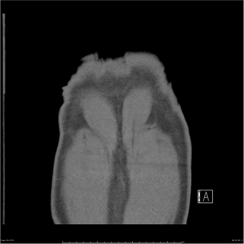 Azygos venous system anatomy (CT pulmonary angiography) (Radiopaedia 25928-26077 Coronal C+ CTPA 80).jpg