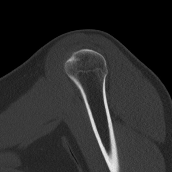 File:Bankart lesion (Radiopaedia 22771-22798 Sagittal bone window 8).jpg