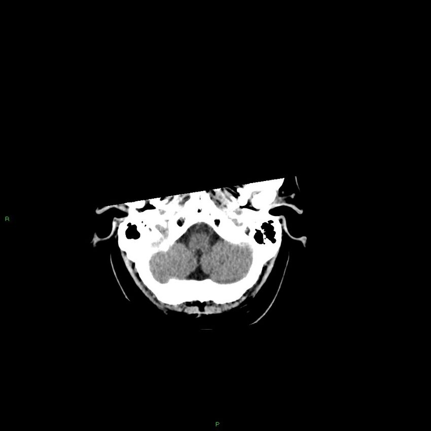 Basal ganglia hemorrhage (Radiopaedia 58346-65467 Axial non-contrast 49).jpg