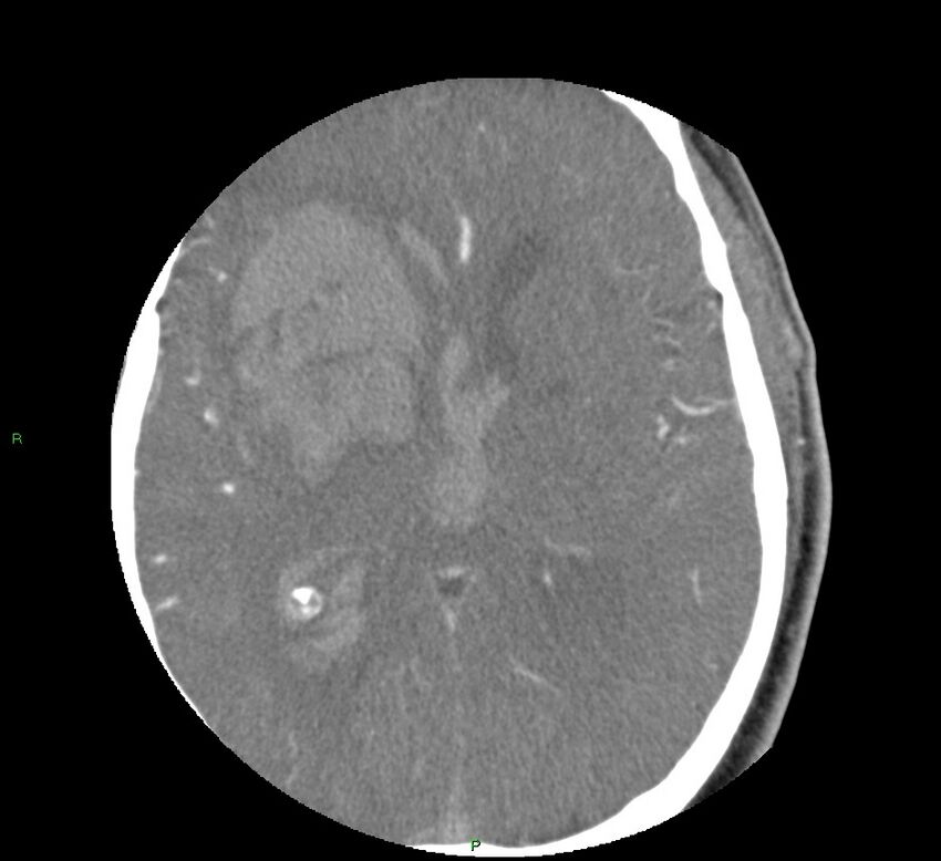 Basal ganglia hemorrhage (Radiopaedia 58763-65985 D 101).jpg