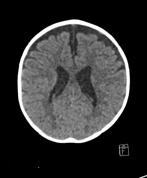 File:Benign enlargement of subarachnoid spaces in infancy (BESS) (Radiopaedia 87459-103795 Axial non-contrast 35).jpg