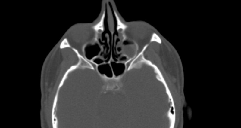 File:Benign mixed salivary tumor of the parotid gland (Radiopaedia 35261-36792 Axial bone window 4).jpg