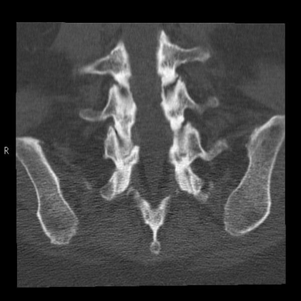 File:Bertolotti syndrome (Radiopaedia 24864-25128 Coronal bone window 35).jpg