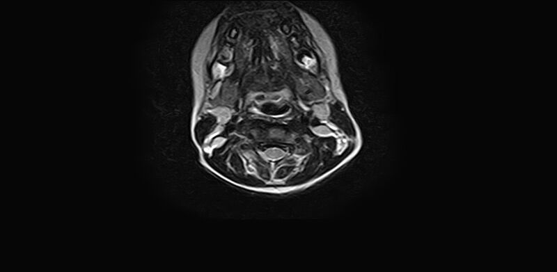 File:Bilateral Sprengel deformity with Klippel-Feil syndrome (Radiopaedia 66395-75650 Axial T2 10).jpg
