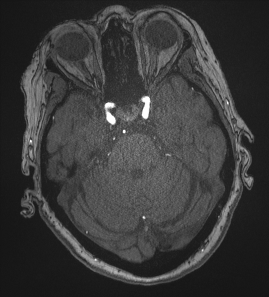 File:Bilateral fetal posterior communicating arteries (Radiopaedia 41286-44102 Axial MRA 60).png