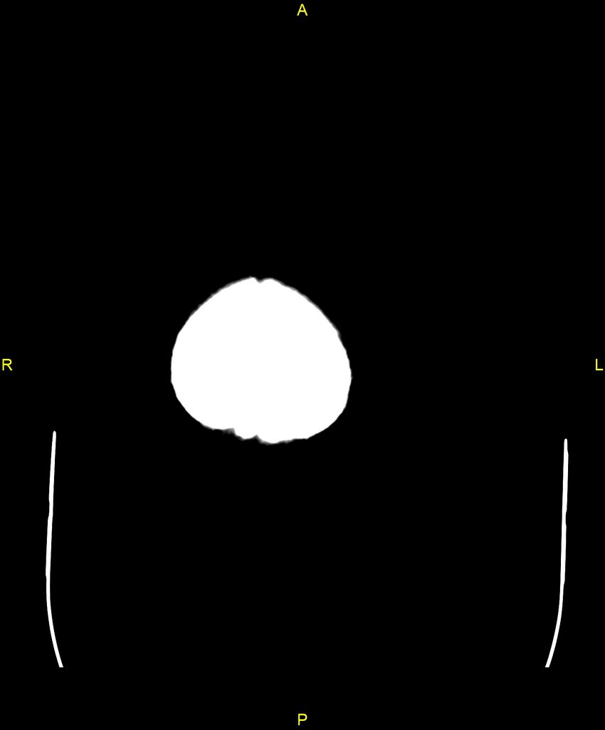Bilateral isodense subdural hematomas (Radiopaedia 88621-105325 Axial non-contrast 110).jpg