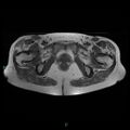 Bilateral ovarian fibroma (Radiopaedia 44568-48293 Axial T1 25).jpg
