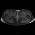 Bilateral ovarian fibroma (Radiopaedia 44568-48293 Axial T1 C+ fat sat 32).jpg